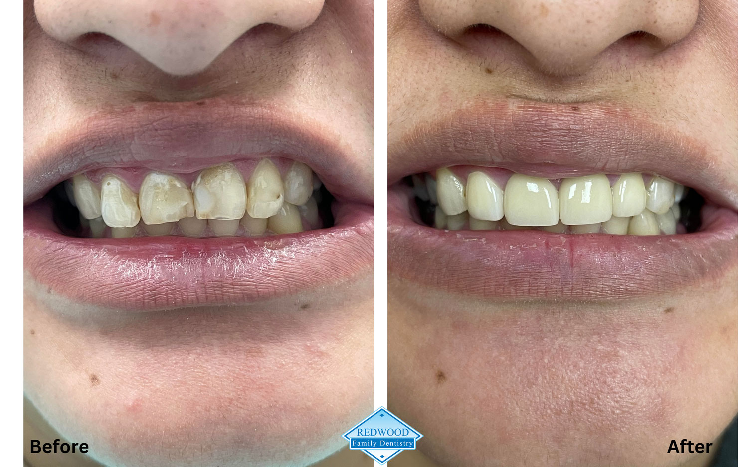 Redwood Family Dentistry patient before & after