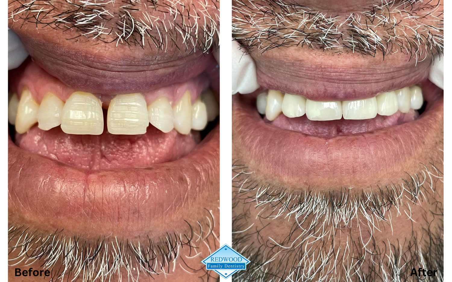 Redwood Family Dentistry patient before & after